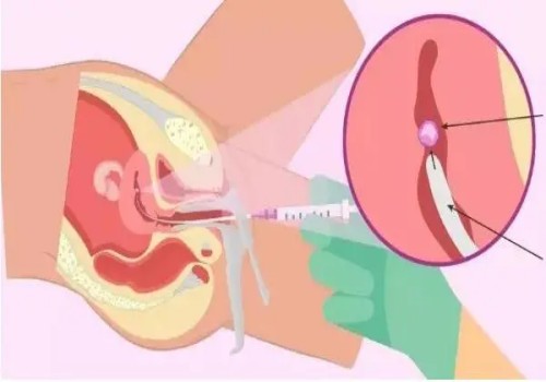 节育环可以不取吗？不取节育环的后果你不可不知